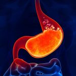 Acid Reflux Disease